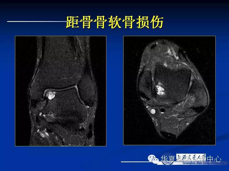 MRI在踝关节损伤中的应用