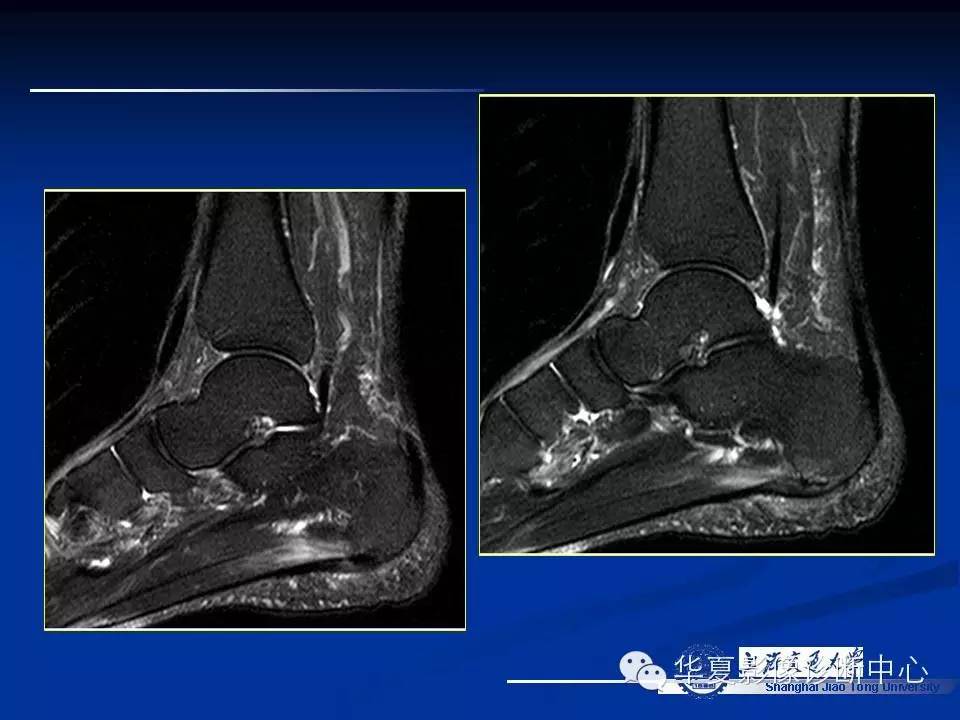 MRI在踝关节损伤中的应用