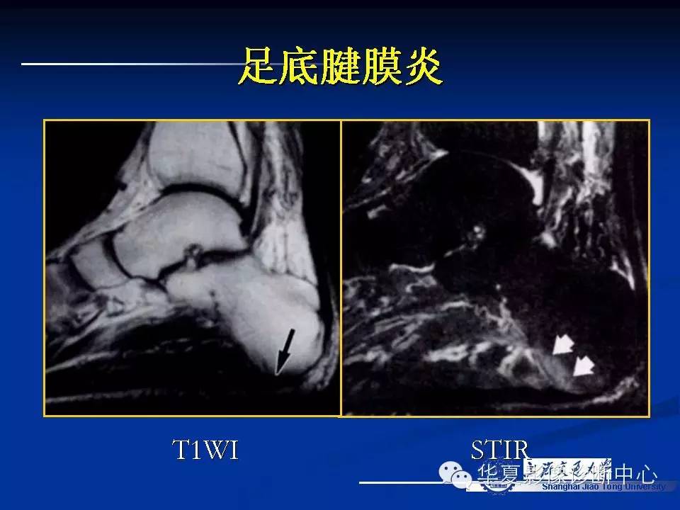 MRI在踝关节损伤中的应用