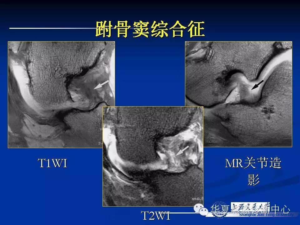 MRI在踝关节损伤中的应用