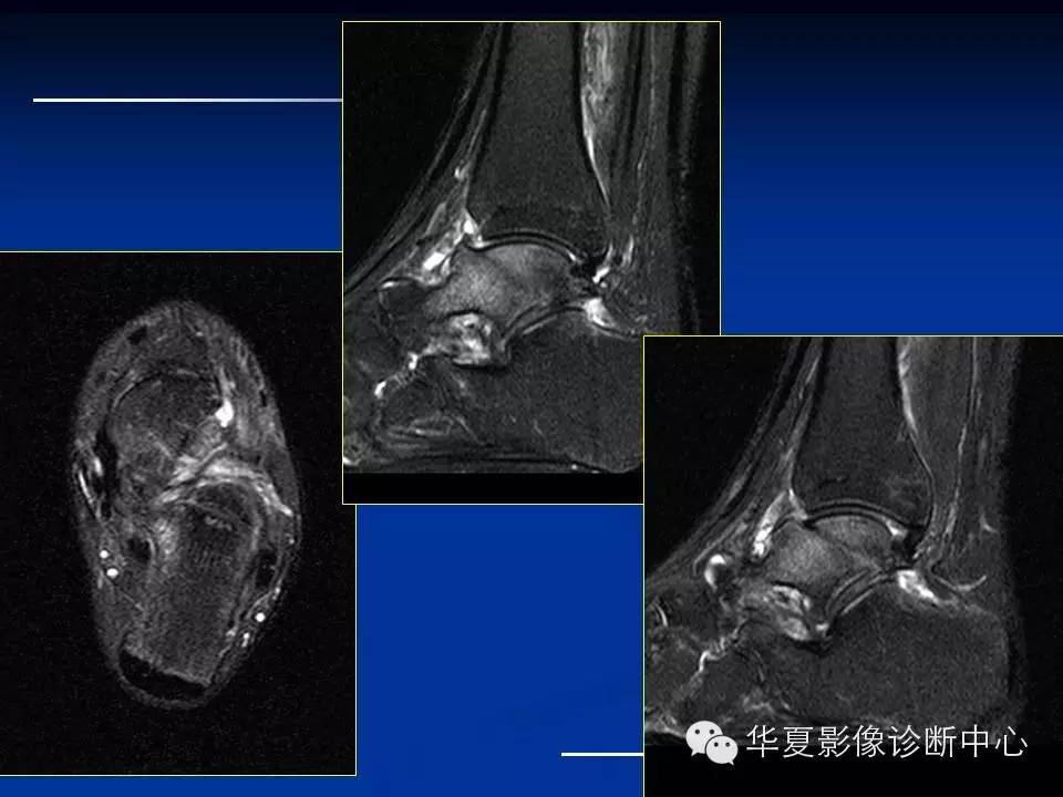 MRI在踝关节损伤中的应用