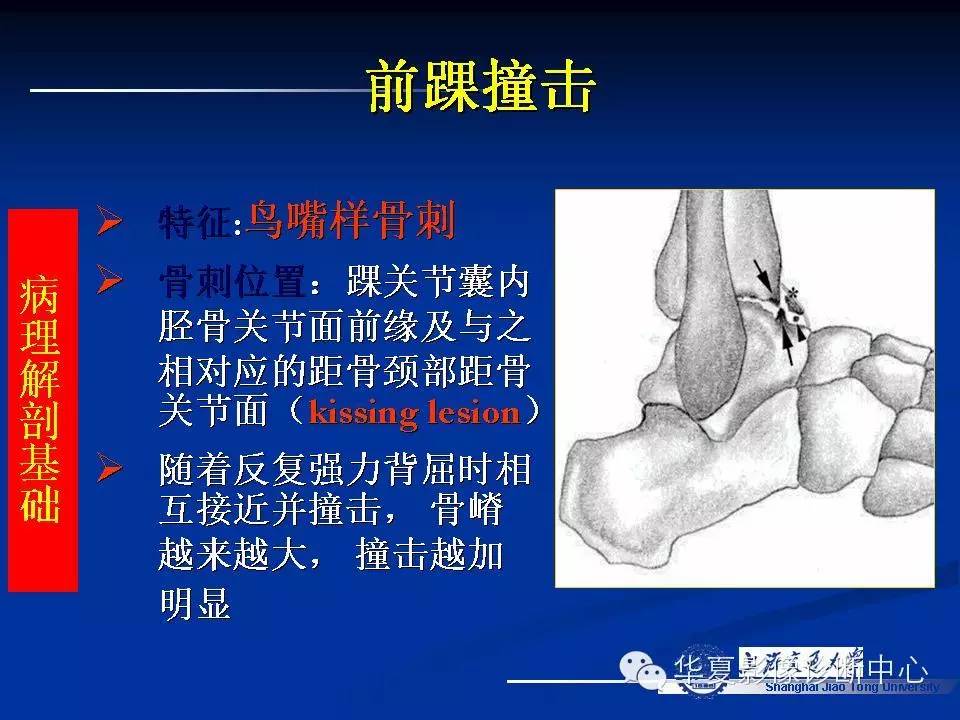 MRI在踝关节损伤中的应用