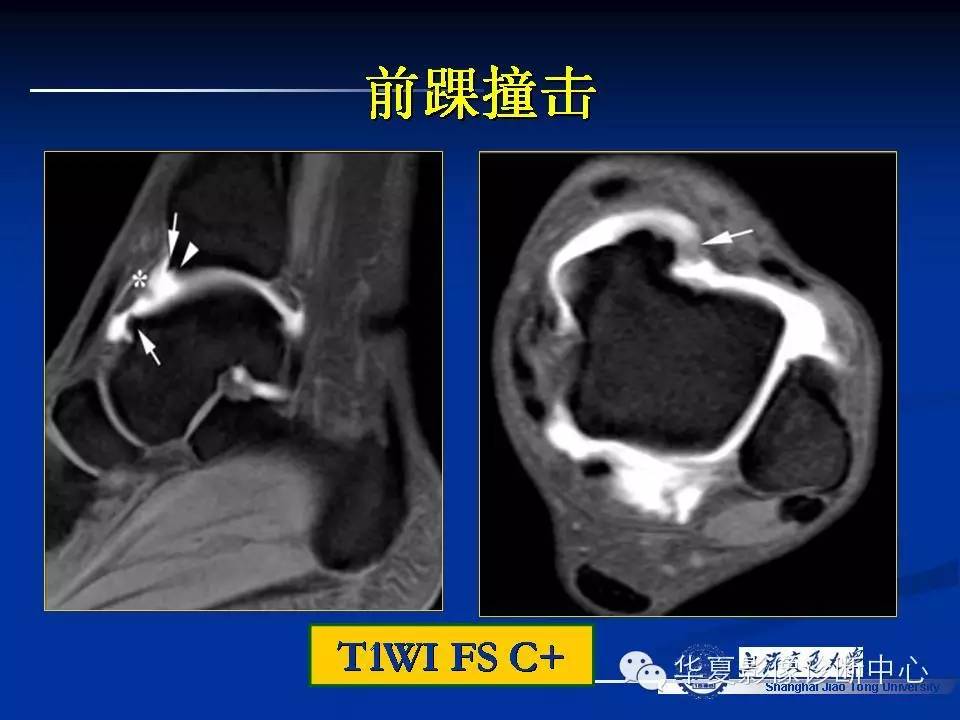 MRI在踝关节损伤中的应用