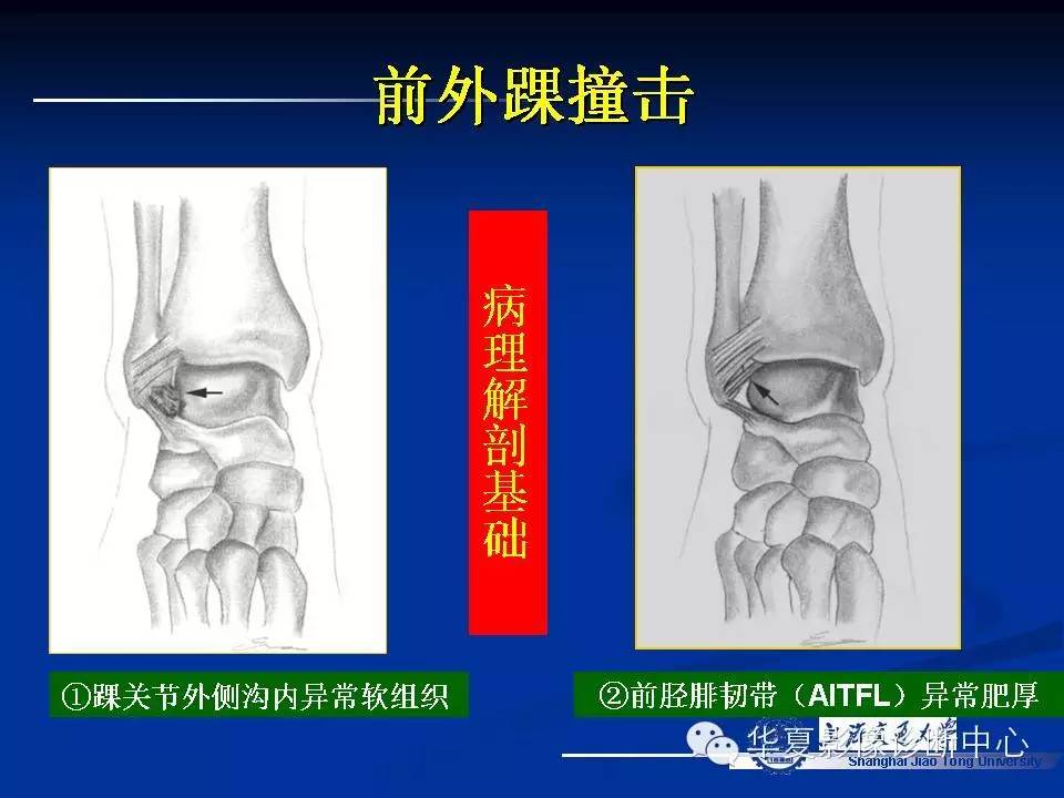 MRI在踝关节损伤中的应用