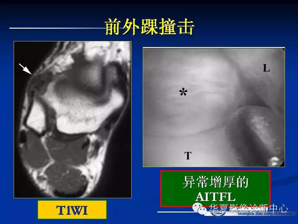 MRI在踝关节损伤中的应用