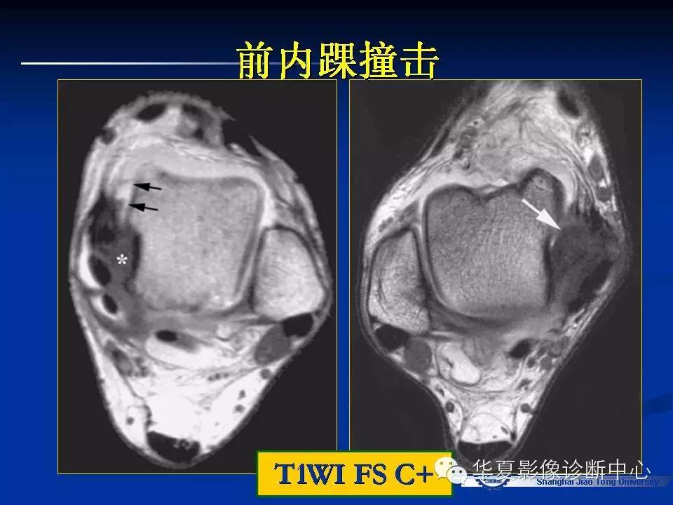 MRI在踝关节损伤中的应用