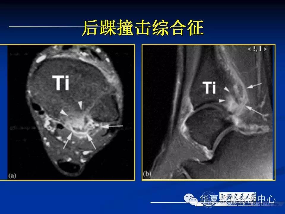 MRI在踝关节损伤中的应用