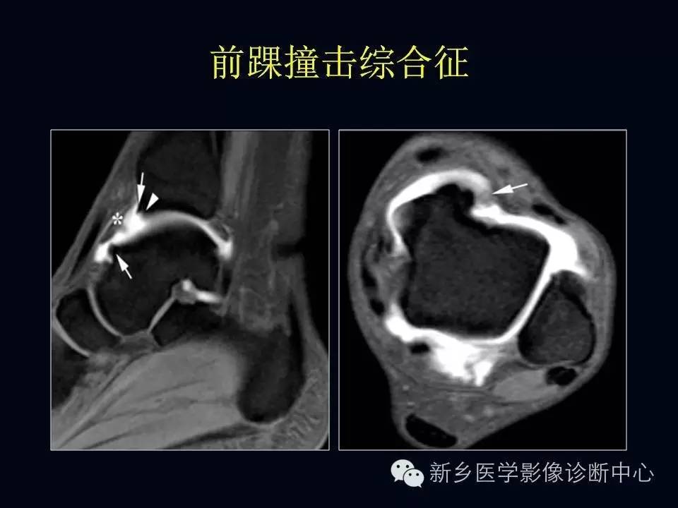 6+1踝关节综合征，您知道吗？