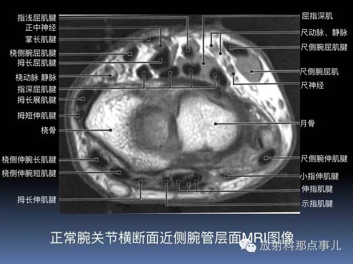 腕关节MRI检查、解剖与常见病变