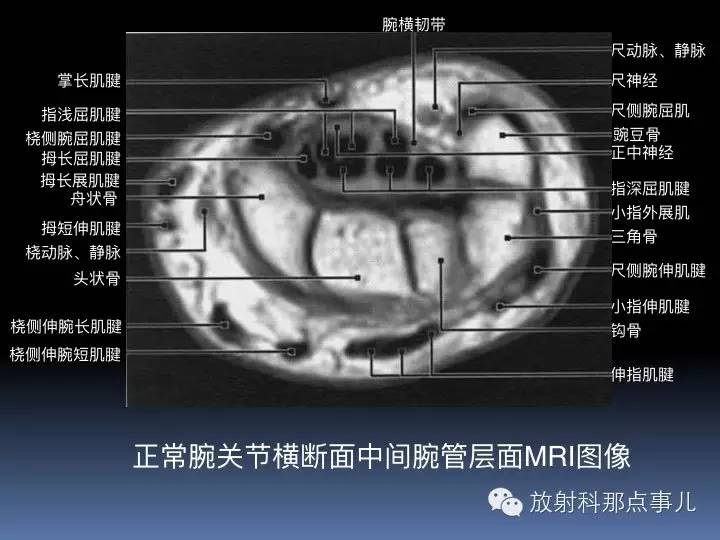 腕关节MRI检查、解剖与常见病变