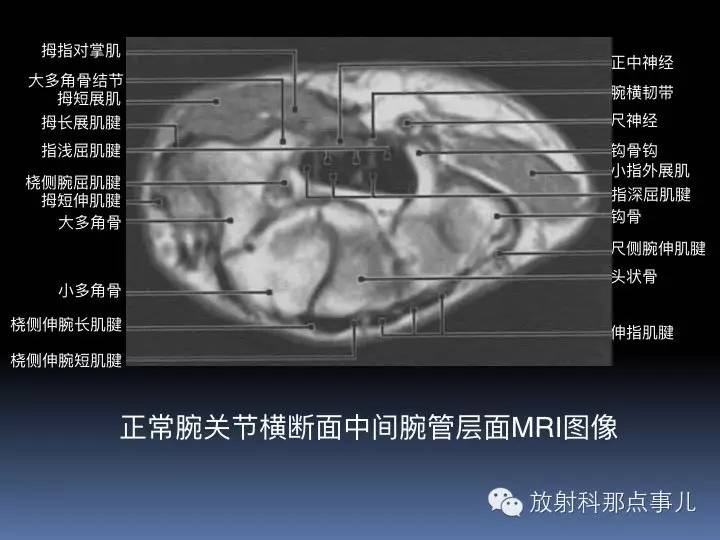 腕关节MRI检查、解剖与常见病变