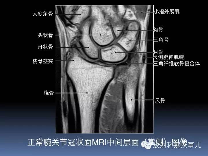 腕关节MRI检查、解剖与常见病变