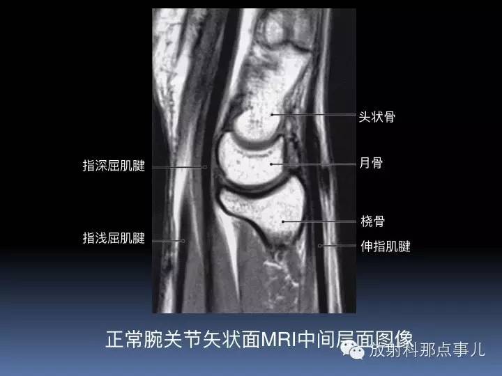 腕关节MRI检查、解剖与常见病变