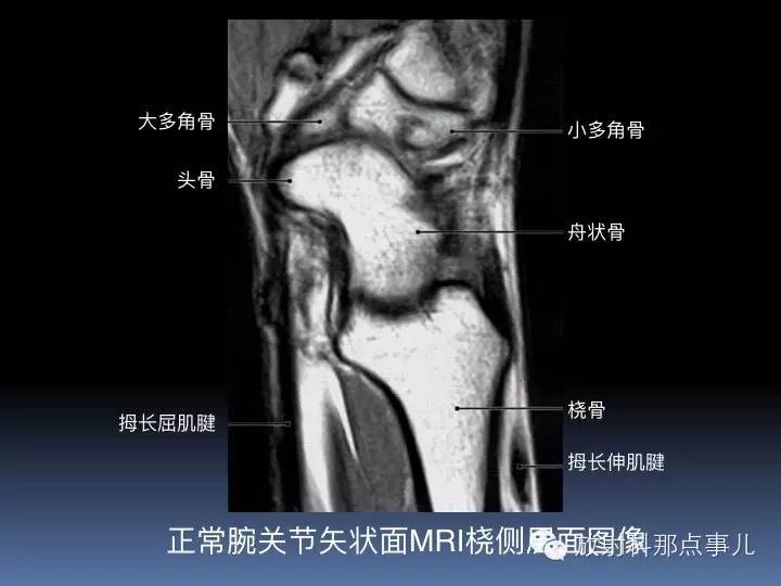 腕关节MRI检查、解剖与常见病变