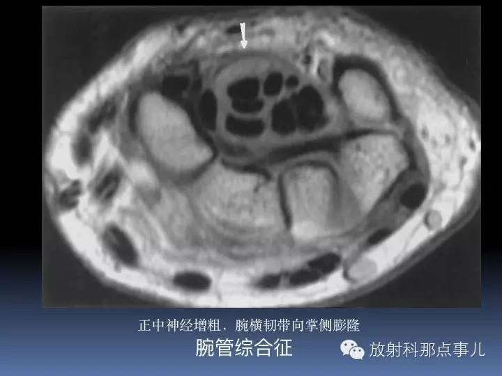 腕关节MRI检查、解剖与常见病变