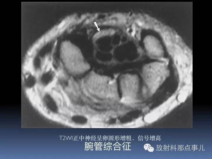 腕关节MRI检查、解剖与常见病变