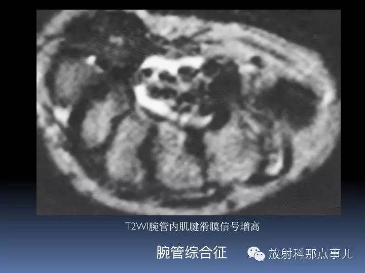 腕关节MRI检查、解剖与常见病变