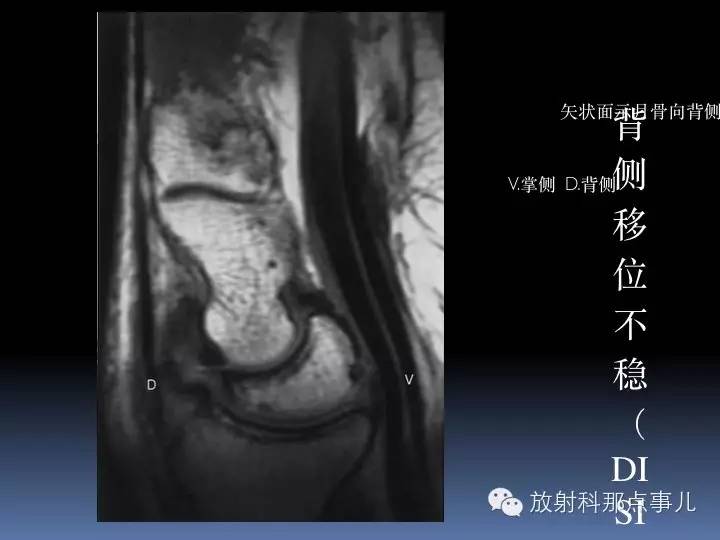 腕关节MRI检查、解剖与常见病变