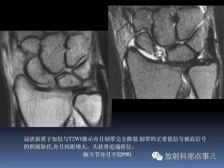 腕关节MRI检查、解剖与常见病变