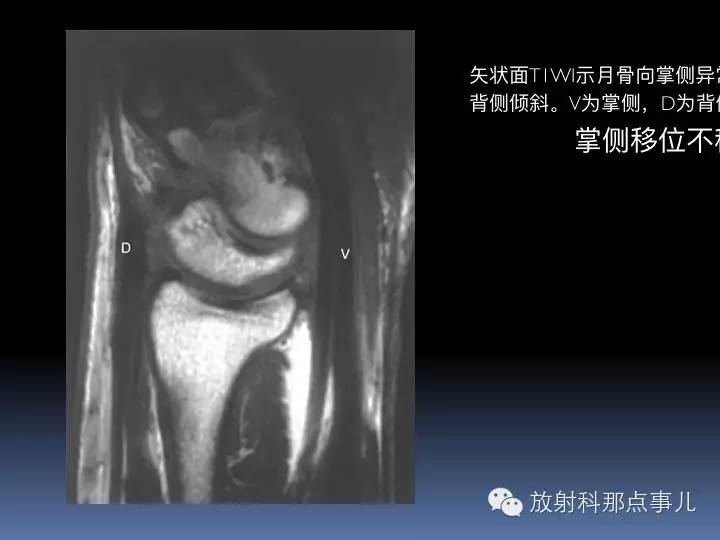 腕关节MRI检查、解剖与常见病变