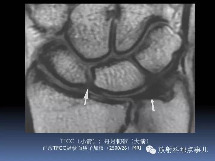 腕关节MRI检查、解剖与常见病变