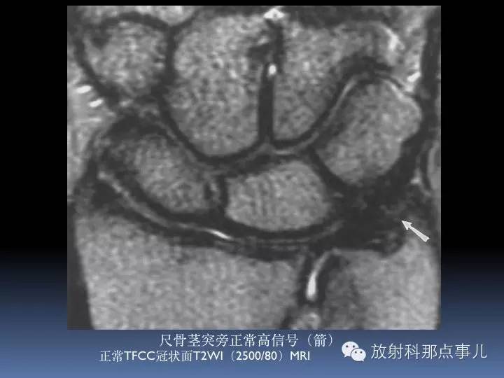 腕关节MRI检查、解剖与常见病变