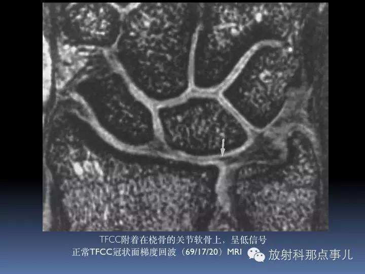 腕关节MRI检查、解剖与常见病变