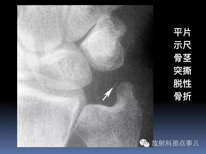 腕关节MRI检查、解剖与常见病变