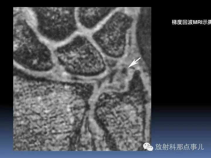 腕关节MRI检查、解剖与常见病变