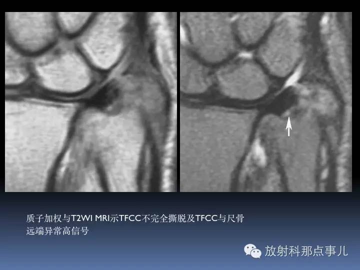 腕关节MRI检查、解剖与常见病变