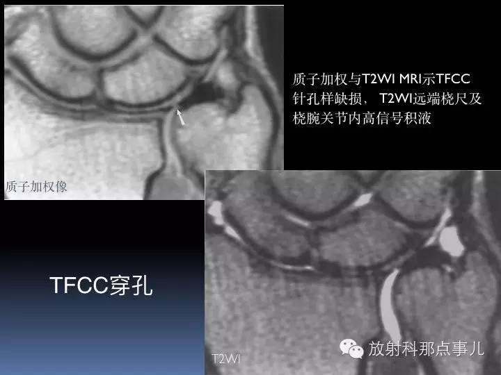 腕关节MRI检查、解剖与常见病变