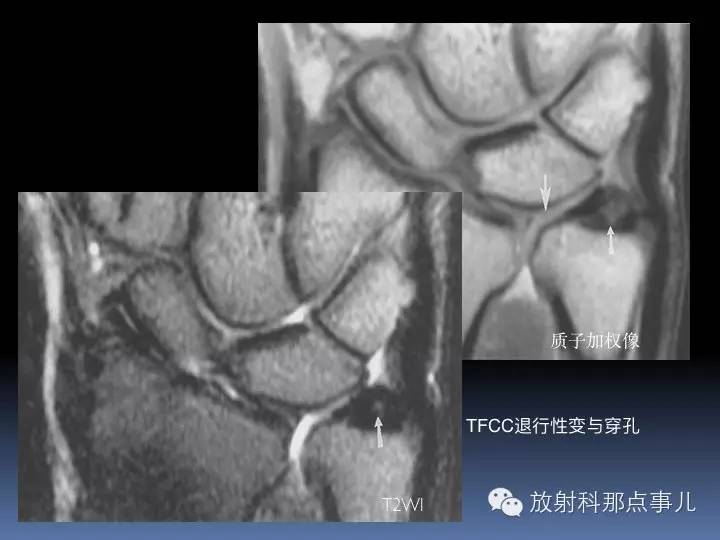 腕关节MRI检查、解剖与常见病变