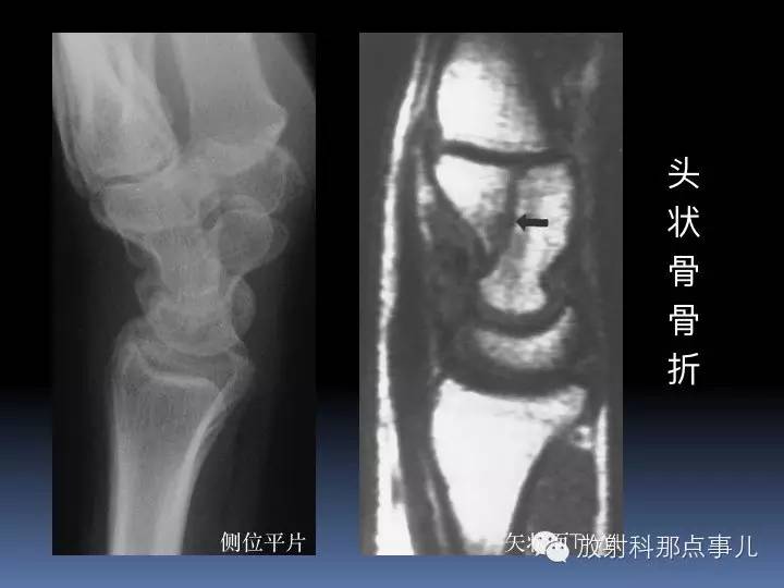 腕关节MRI检查、解剖与常见病变