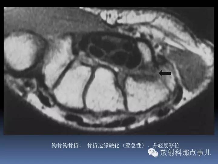 腕关节MRI检查、解剖与常见病变