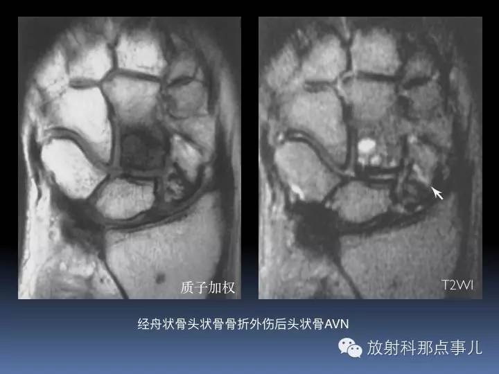 腕关节MRI检查、解剖与常见病变