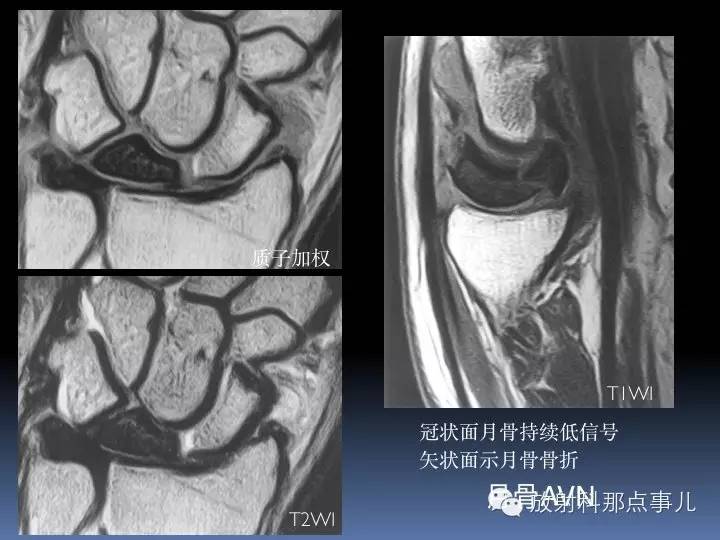 腕关节MRI检查、解剖与常见病变