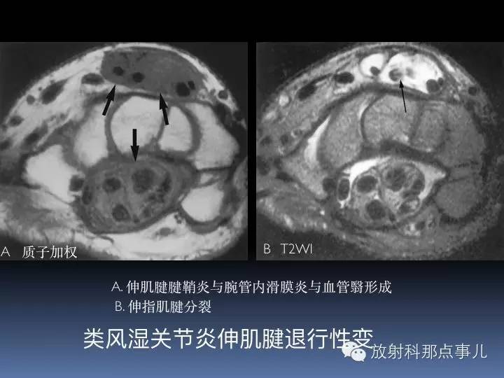 腕关节MRI检查、解剖与常见病变