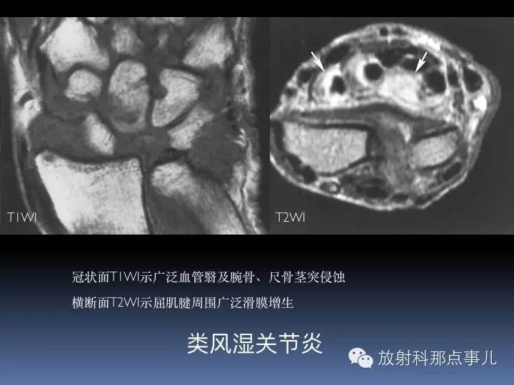 腕关节MRI检查、解剖与常见病变