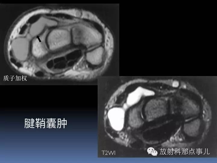 腕关节MRI检查、解剖与常见病变