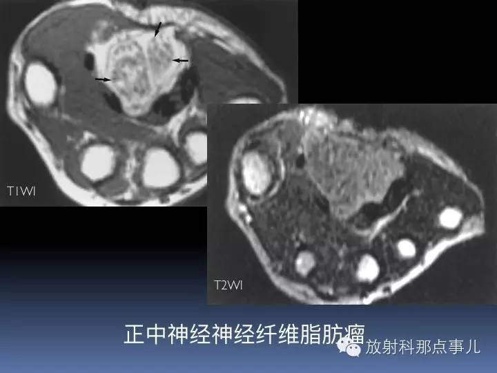 腕关节MRI检查、解剖与常见病变