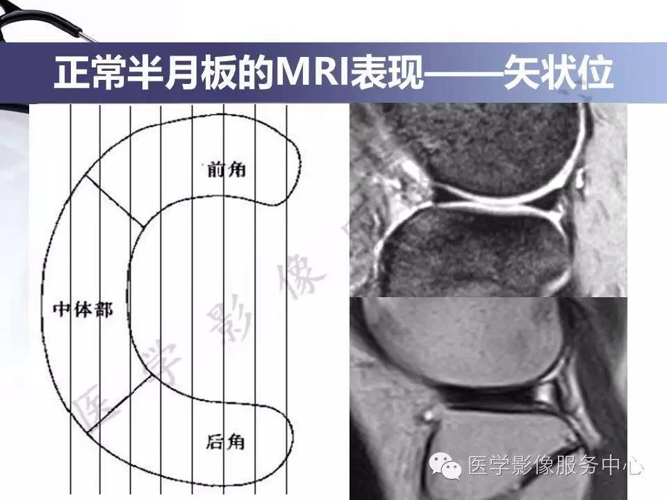 半月板病变的MRI诊断，如此精彩岂能错过！