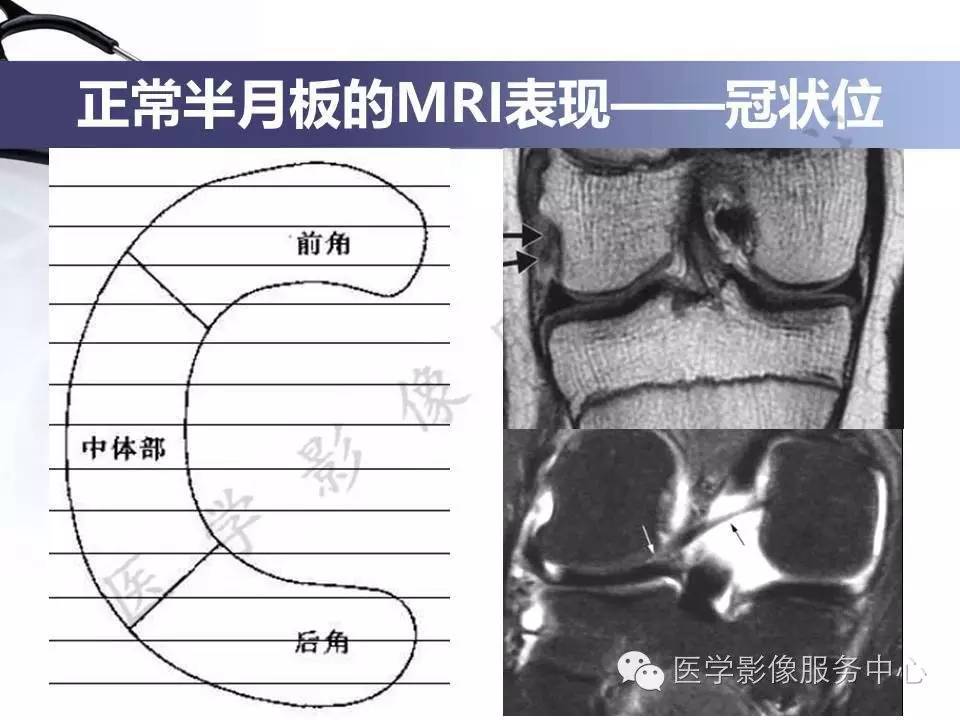 半月板病变的MRI诊断，如此精彩岂能错过！