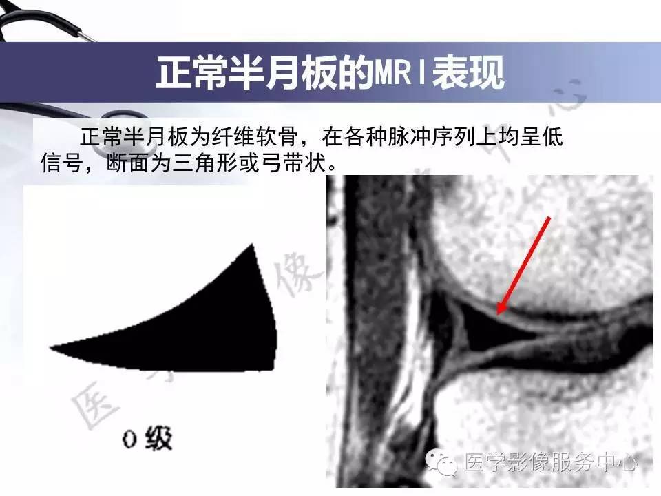 半月板病变的MRI诊断，如此精彩岂能错过！