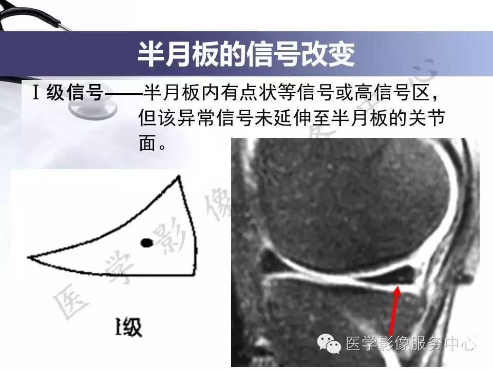 半月板病变的MRI诊断，如此精彩岂能错过！