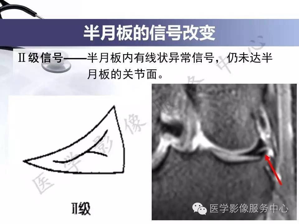 半月板病变的MRI诊断，如此精彩岂能错过！