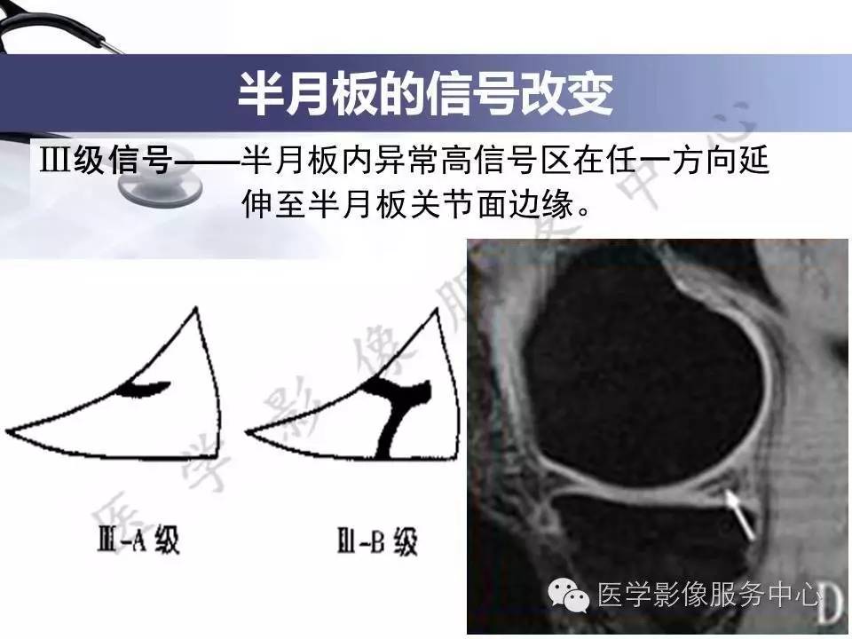 半月板病变的MRI诊断，如此精彩岂能错过！