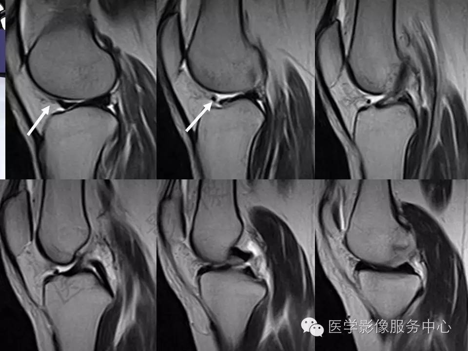半月板病变的MRI诊断，如此精彩岂能错过！