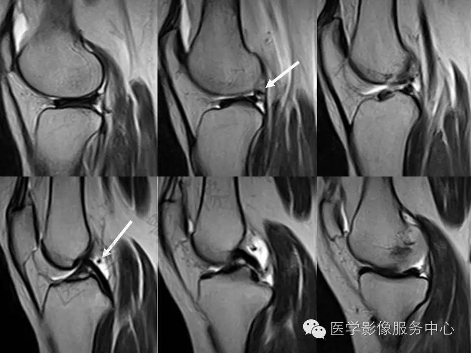 半月板病变的MRI诊断，如此精彩岂能错过！