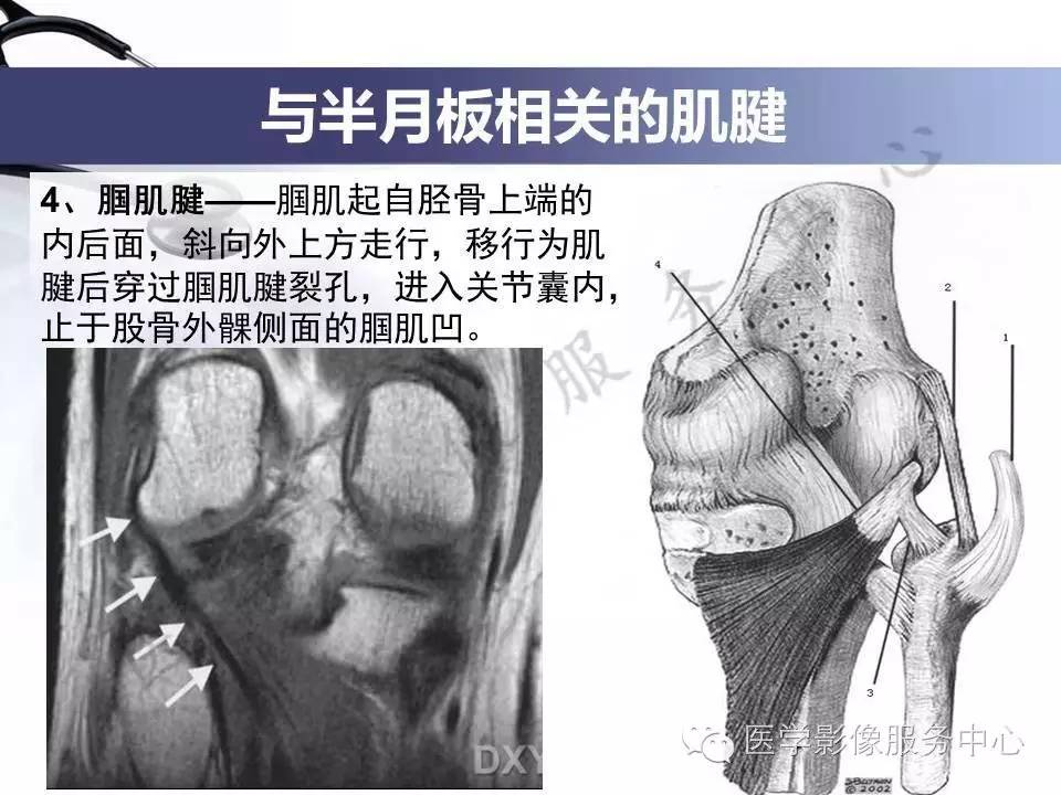 半月板病变的MRI诊断，如此精彩岂能错过！