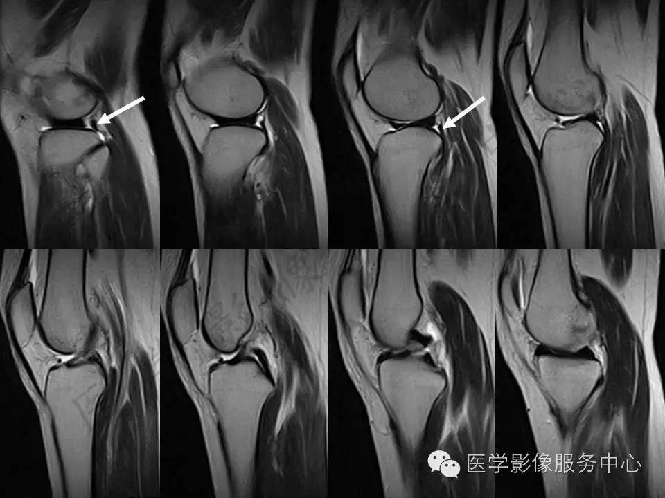 半月板病变的MRI诊断，如此精彩岂能错过！